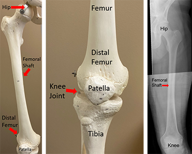 bone remodeling x ray