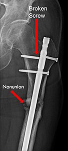 X-rays of a left femur fracture 9 months after fixation with an intramedullary nail