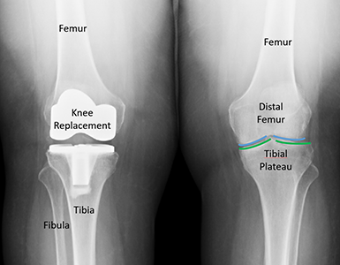 A patient who has one knee replaced and one that is not replaced