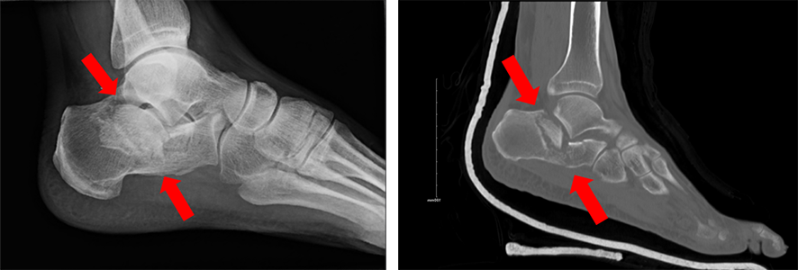 X-ray and CT images of a compression type fracture of the calcaneus with flattening and widening of the bone