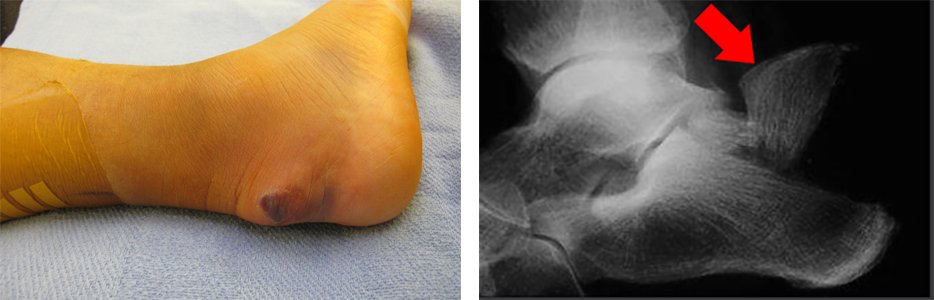 Fracture of the calcaneus due to the pull of the calf muscles with threatened skin at the back of the heel from the displaced bone fragment