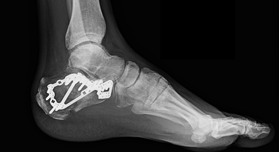 Compression type calcaneus fracture realigned and fixed with a plate and screws