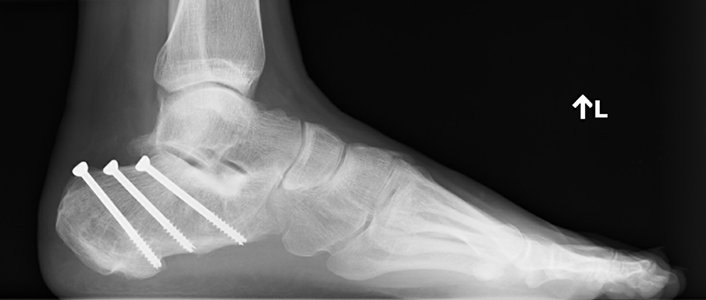 Tension type calcaneus fracture realigned and fixed with screws