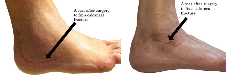 Healed scars on the lateral part of the back of the foot from calcaneus fracture surgery