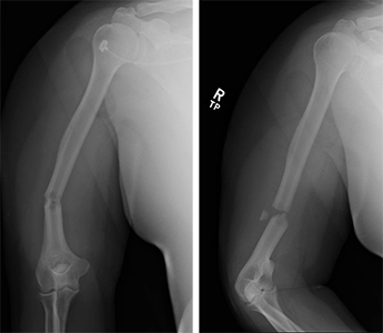 X-rays of a humeral shaft fracture near the bottom of the bone