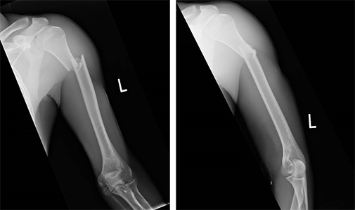 X-rays of a humeral shaft fracture near the top of the bone