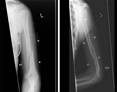 X-rays of a humerus fracture treated in a Sarmiento brace