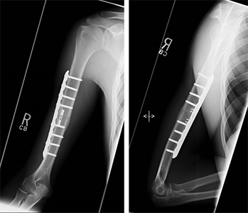 Humeral fracture after it has been fixed with a plate and screws