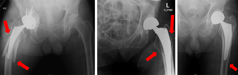 Red arrows indicate fractures that have occurred near the hip implants