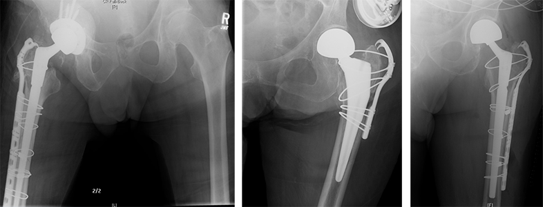 X-rays showing various hip implants