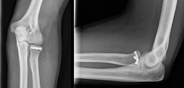 Radial head fracture fixed with screws only