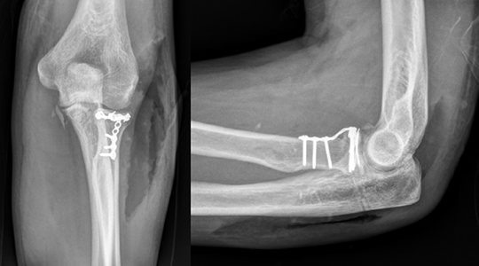 Radial head fracture fixed with plates and screws