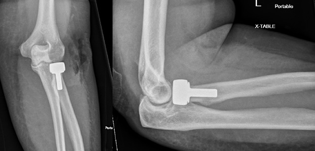 Radial head fracture fixed with a radial head replacement