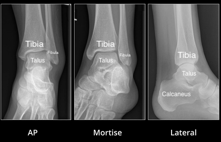  X-rays showing normal talus bone, and its relationship to the shin bone (tibia), outer ankle bone (fibula), and heel bone (calcaneus).