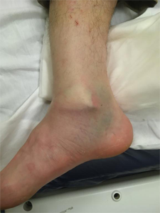 Figure 4: Clinical photo of an ankle fracture dislocation with bruising, swelling and skin tenting from the fracture.