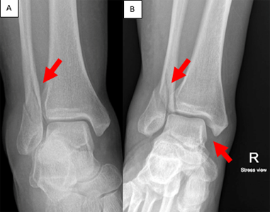 Figure 5: A) Fracture of fibula (lateral malleolus), B) Fracture of the lateral malleolus with associated deltoid ligament sprain results in translation (instability) of the ankle joint.