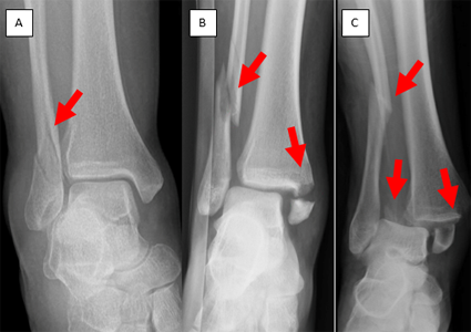 Figure 6: A) Fracture of fibula only, B) fracture of fibula and tibia, C) Fracture of fibula and tibia (2 parts). Stable fractures can sometimes be treated in a cast or boot. As instability worsens, surgery is needed. You will need to talk to you doctor about your specific injury to get details on which type of ankle fracture you may have and if surgery is needed.