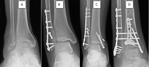 Figure 7: X-rays of A) Non-operatively treated lateral malleolus fracture, B) operatively treated lateral malleolus fracture, C) operatively treated bimalleolar ankle fracture, D) operatively treated trimalleolar ankle fracture.