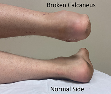 Fracture du calcanéum qui a été traitée sans chirurgie et qui a guéri dans une position qui rend le pied large et court.
