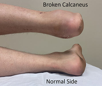 Ankle fracture: natural healing