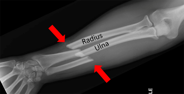 forearm hairline fracture
