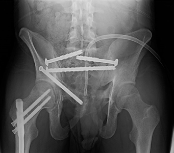 Pelvis Fracture  Orthopaedic Trauma Association (OTA)