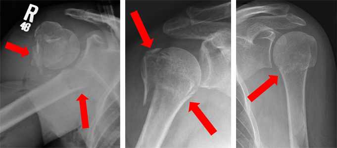 Fracture lines separating the proximal humerus into 2, 3 or 4 parts.