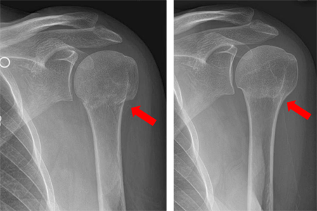 X-rays of a 2-part proximal humerus fracture treated without surgery.