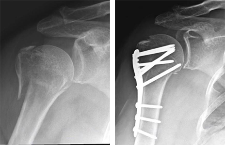 Figure 6: X-rays of a 3-part proximal humerus fracture before and after surgery.
