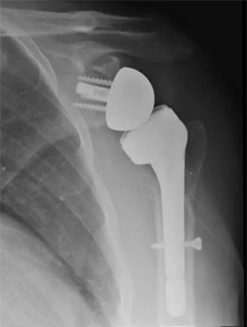 X-ray of a shoulder replacement.
