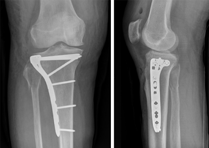 X-rays of a knee after tibial plateau fracture surgery, with plate and screws.