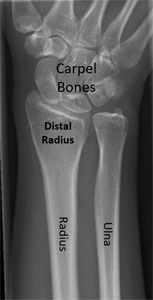 Normal x-ray showing the distal radius and how it contributes to the wrist joint.