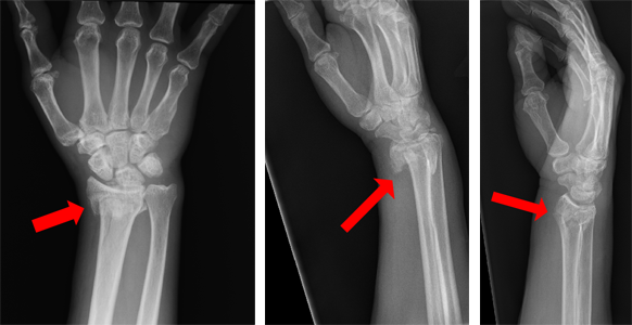 X-rays showing three different views of a distal radius fracture.