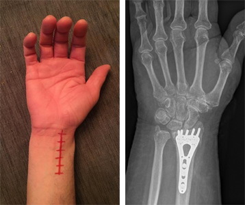 Image on the left shows location of the incision made during surgery. X-ray on the right shows a distal radius fracture after surgery with plate and screws.