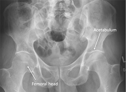 X-ray of the pelvis demonstrating the femoral head and the acetabulum where the femoral head articulates.