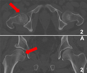 Example of a femoral head fracture on CT scan.
