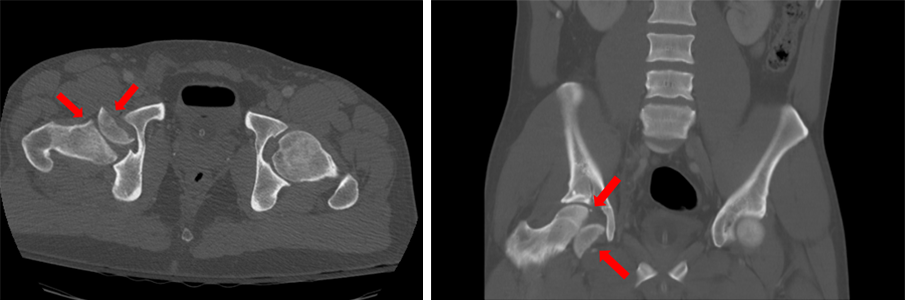 An extreme example of a femoral head fracture, in which the piece was flipped the wrong way.