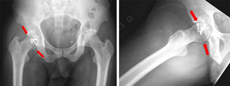 A femoral head fracture fixed with screws.