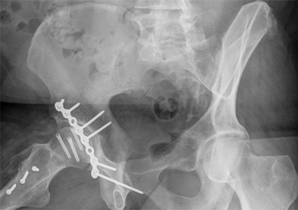 A femoral head fracture and a hip socket fracture fixed with plates and screws.