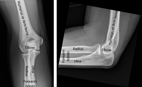 X-rays of the elbow with the major structures labeled.