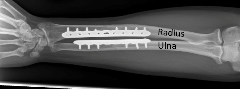X-ray showing a &quot;both bones&quot; forearm fracture treated with plates and screws.