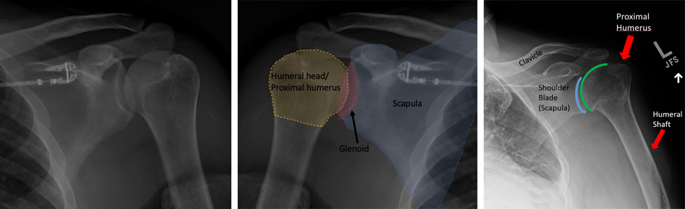 X-ray of a normal shoulder.