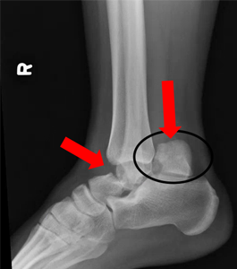 Lateral or side view x-ray showing fracture dislocation of talus bone.