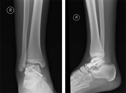 Front and side view x-rays showing a fracture that was fixed with plate and screws.