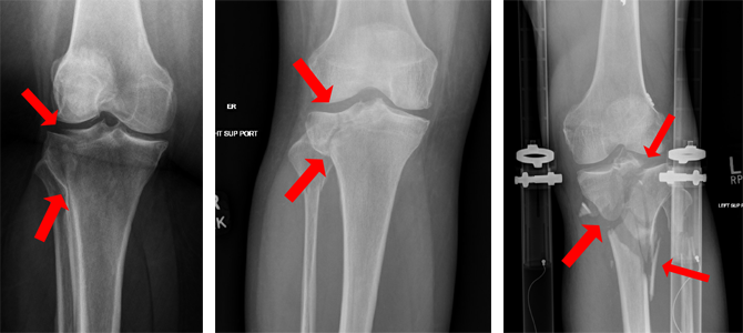 An example of a patient with a tibial plateau fracture.