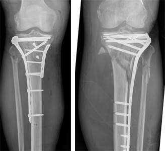X-rays of a patient that broke both tibial plateaus very badly. 