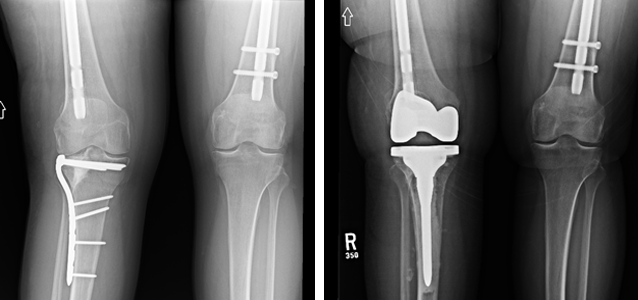 X-rays of post-traumatic arthritis after a tibial plateau fracture.
