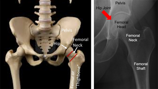 A model of a hip and pelvis, and an x-ray showing the femoral neck.
