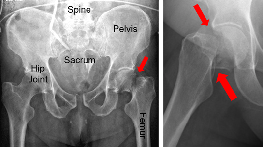 X-rays of a femoral neck fracture.