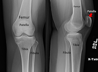 X-rays of the knee from the front and from the side.